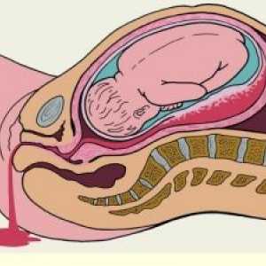 Sangerare rectala in timpul sarcinii