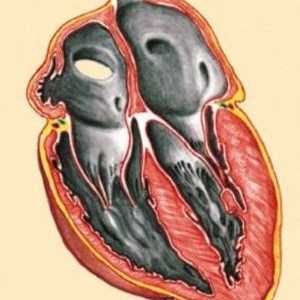 Cardiomiopatie restrictivă