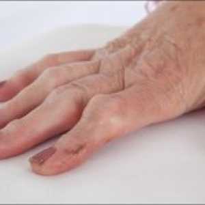 Artrita reumatoida a degetelor: simptome, tratament, cauze, simptome