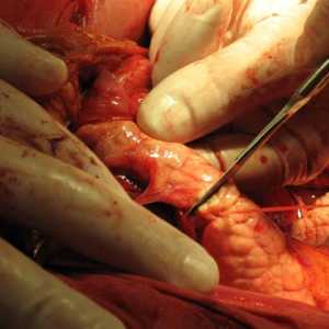 Rezecția capului și coada pancreasului distal și consecințele sale