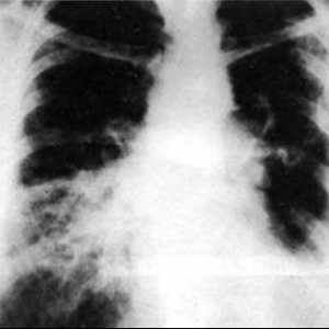 Rezultatele biopsiei pulmonare Thoracoscopic