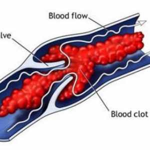 Rolul factorilor morfologice și funcționale în dezvoltarea trombozei