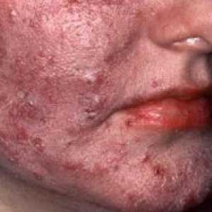 Pielea de acnee rozacee: tratament, simptome, cauze, simptome
