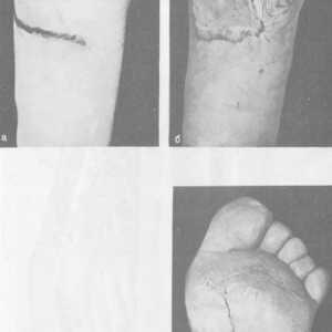 Scar deformare a piciorului si glezna. Ulcer pe suprafața plantară a arcului piciorului