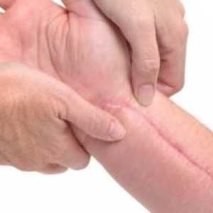 Cicatricile: Tratament, cauze, tipuri, de prevenire, cum să scape