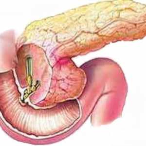 Pancreas Loose și denivelate