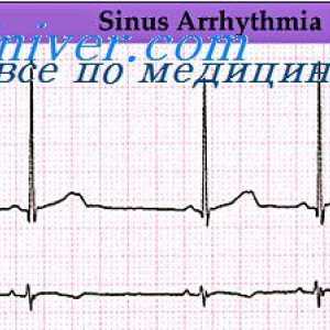 Aritmii cardiace. Violarea ritmului nodului sinusal
