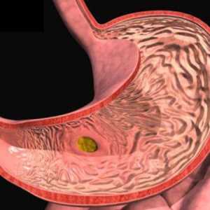 Simptome gastrita si tratament
