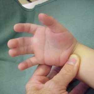 Syndactyly degetelor: cauze, simptome, tratament, simptome