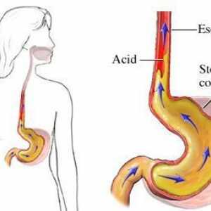 Sindromul de esofagita de reflux