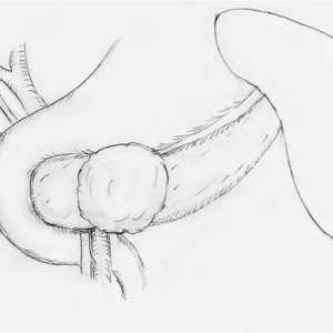 Tumoare Pseudopapillary-solid a pancreasului