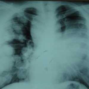 Nodul pulmonar solitar