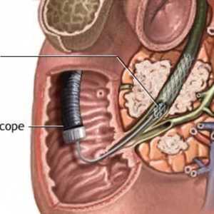 Stentarea pancreasului