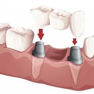 Dispozitive dentare: poduri, proteze partiale si complete amovibile