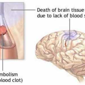 Subarahnoidiană hemoragie, consecințe, tratament, simptome