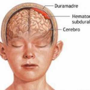 Subdural hematom cerebral: implicații de tratament