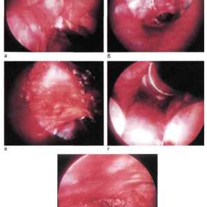 Tehnica mediastinoskopicheskoy-cervico-mediastinal ocluzie ciot bronhie principală
