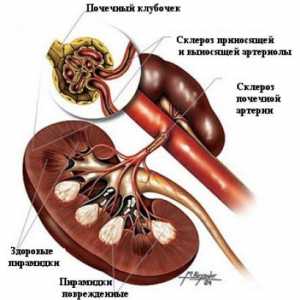 Boala renală în stadiu terminal (insuficiență renală cronică), diabet