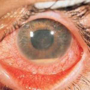 Toxoplasmoza retinohorioidit