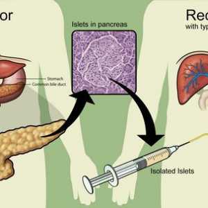 Transplantul de pancreas