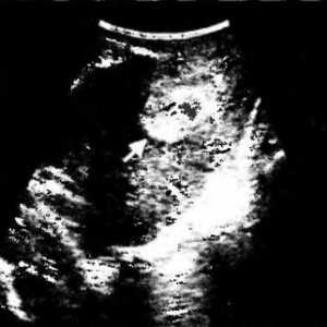 Diagnostic cu ultrasunete transvaginala de endometrita postpartum