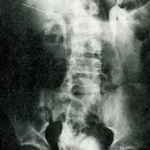 Trauma tractului urinar și a abdomenului. deteriorarea ureter