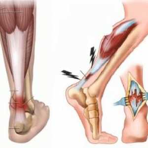 Leziuni traumatice și inflamații ale tendoanelor