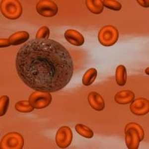 Tulburări plachetelor sanguine: hemostaza, pot fi identificate?
