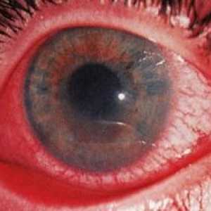 Uveita oculară: tratament, simptome, cauze, simptome, diagnostic