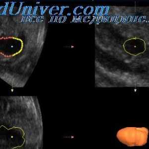 Uzi fetale ulcer duodenal. Diagnosticul de atrezie duodenală la fetuși