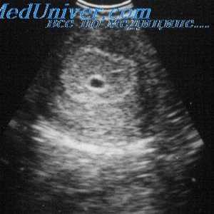 Ultrasunete în primul trimestru de sarcină. Indicații pentru ecografie transvaginala în primul…