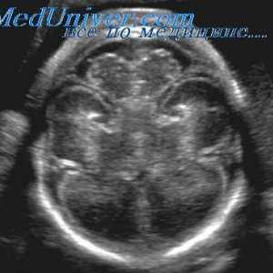 Ingrijire prenatala cu Ventriculomegalie. hidrocefalie congenitală