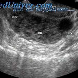 Tipuri de sarcină extrauterină. Localizarea sarcinii ectopice