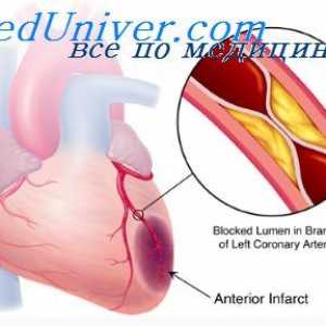 Fibrilație ventriculară după infarct miocardic. ruptură ventriculara peretelui miocardic în zona