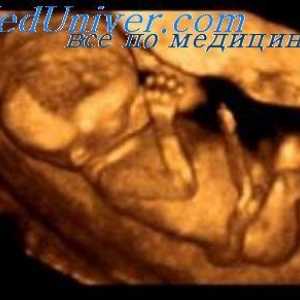 Amputarea congenitală a fătului. Sindromul aglossia-adactylia