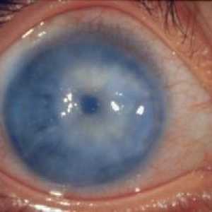 Ochi glaucom secundar: tratament, cauze, clasificare, simptome, semne