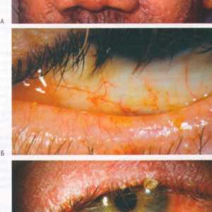 Boli ale rozacee oculară conjunctivă