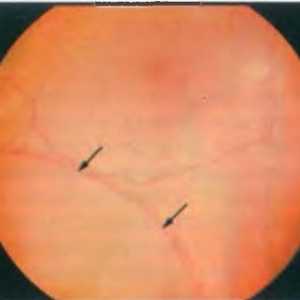 Boli ale periferiei retinei: retinoschisis degenerative
