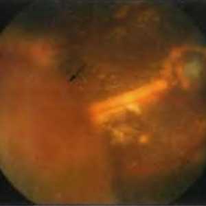 Boli ale periferiei retinei: dezlipire de retina exudativă