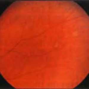 Boli ale periferiei retinei: fasciculul vitreoretinal și pliul meridional