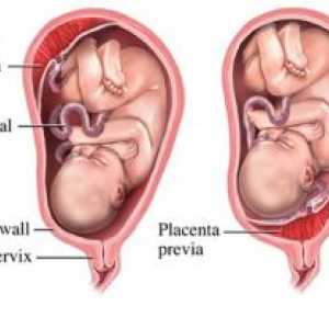 Întârzierea in uter si placenta din piesele sale