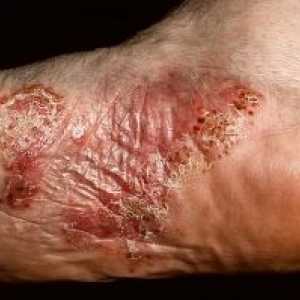 Dermatita de staza: tratament