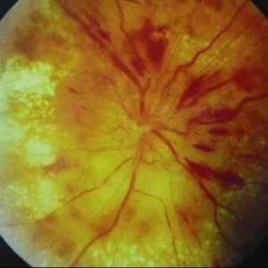 Disc optic congestive cu sindrom hipertensiune hidrocefalie