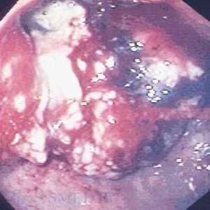 Cancerul de stomac glandulara