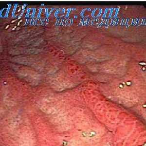 Atrofia gastrică. ulcer peptic