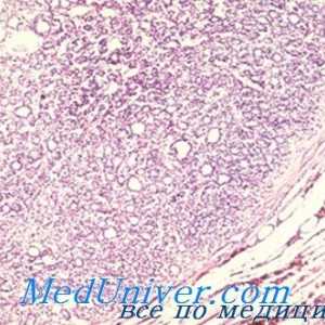 Maligne tiroidiene adenom morfologiei