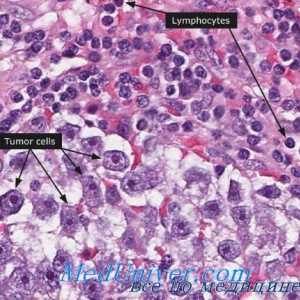 Cancer testicular. androblastoma testicul