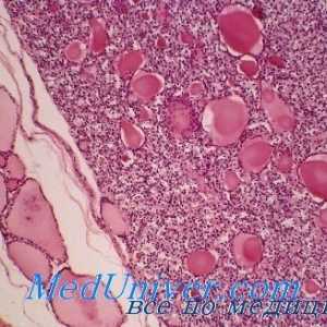 Neoplasmele maligne ale simptomelor tiroidiene, clasificarea