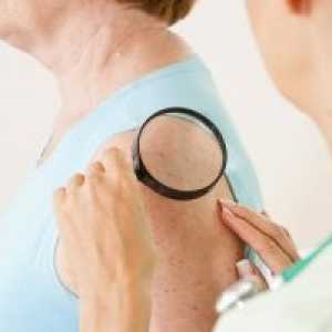 Tumorile maligne ale pielii: clasificare